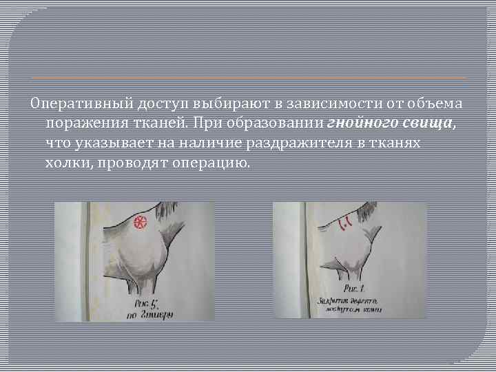 Оперативный доступ выбирают в зависимости от объема поражения тканей. При образовании гнойного свища, что