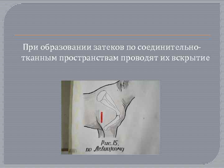 При образовании затеков по соединительнотканным пространствам проводят их вскрытие 