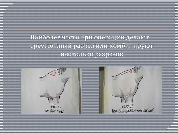  Наиболее часто при операции делают треугольный разрез или комбинируют несколько разрезов 
