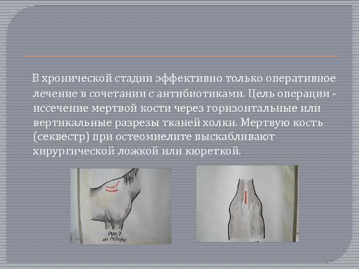  В хронической стадии эффективно только оперативное лечение в сочетании с антибиотиками. Цель операции