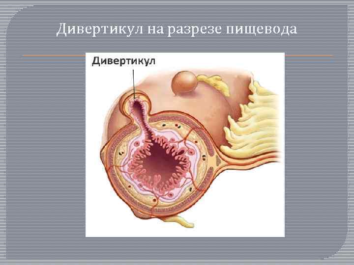 Дивертикул на разрезе пищевода 