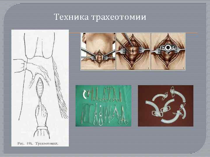  Техника трахеотомии 