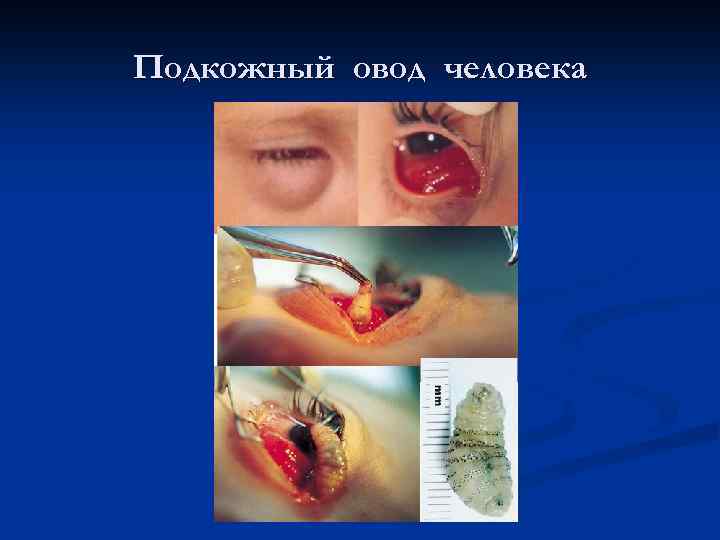 Подкожный овод человека 