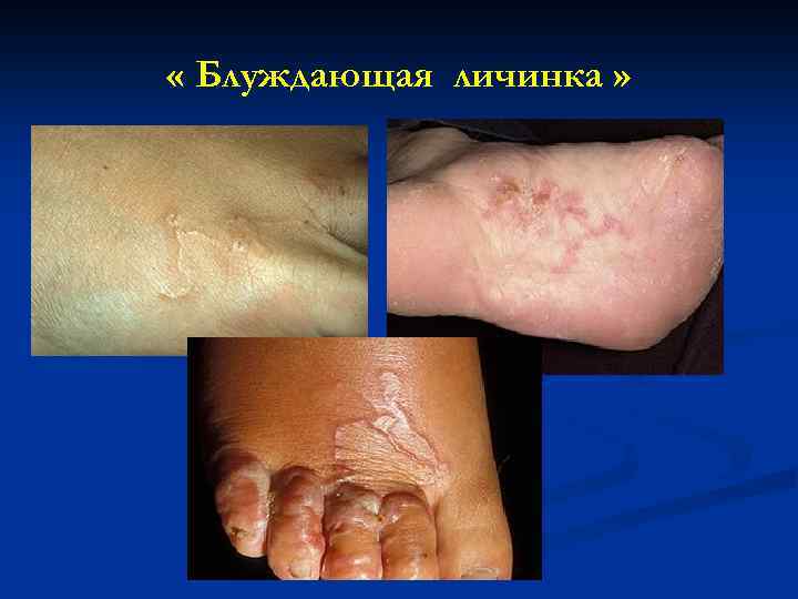  « Блуждающая личинка » 