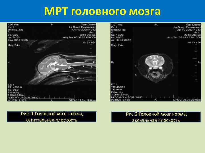 МРТ головного мозга Рис. 1 Головной мозг норма, сагиттальная плоскость Рис. 2 Головной мозг
