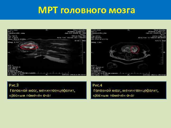  МРТ головного мозга Рис. 3 Головной мозг, менингоэнцефалит, красным помечен очаг Рис. 4