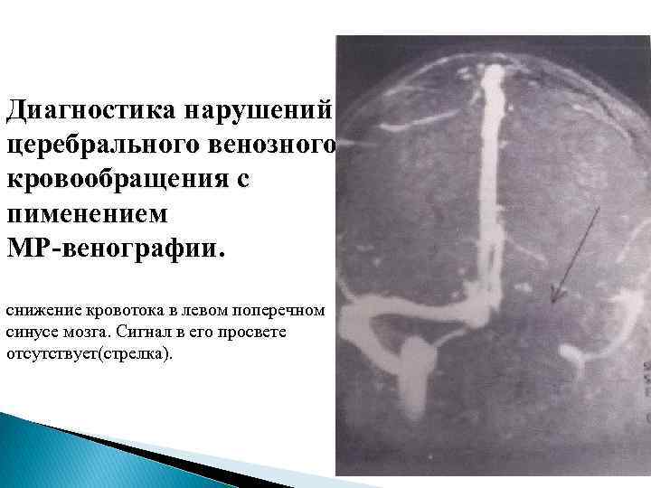 Венозная аномалия головного мозга. Гипоплазия левого венозного поперечного синуса поперечного. Венозная недостаточность головного мозга. Нарушение венозного кровотока. Отсутствие левого поперечного синуса.