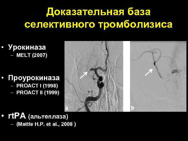 Доказательная база селективного тромболизиса • Урокиназа – MELT (2007) • Проурокиназа – PROACT I