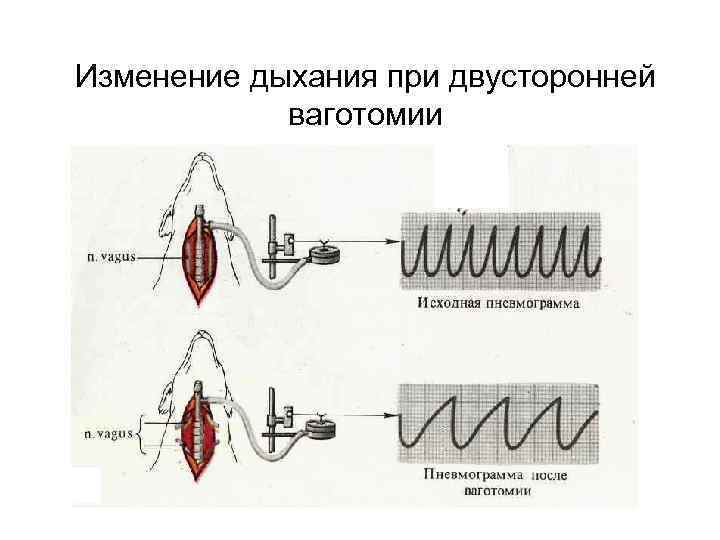 Изменение дыхания при двусторонней ваготомии 