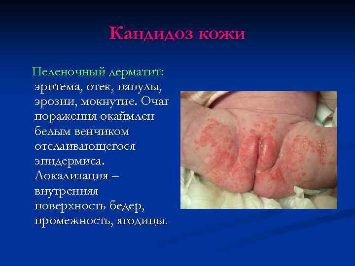 Кандидоз кожи Пеленочный дерматит: эритема, отек, папулы, эрозии, мокнутие. Очаг поражения окаймлен белым венчиком