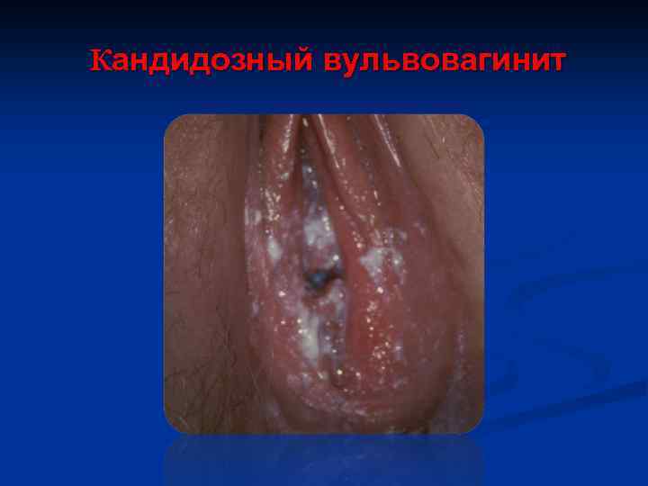 Кандидозный вульвовагинит 