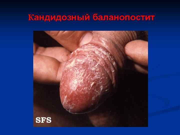 Кандидозный баланопостит 