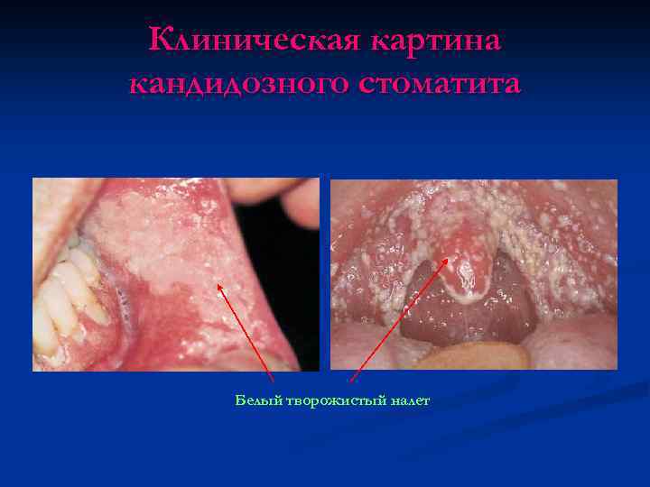 Клиническая картина кандидозного стоматита Белый творожистый налет 