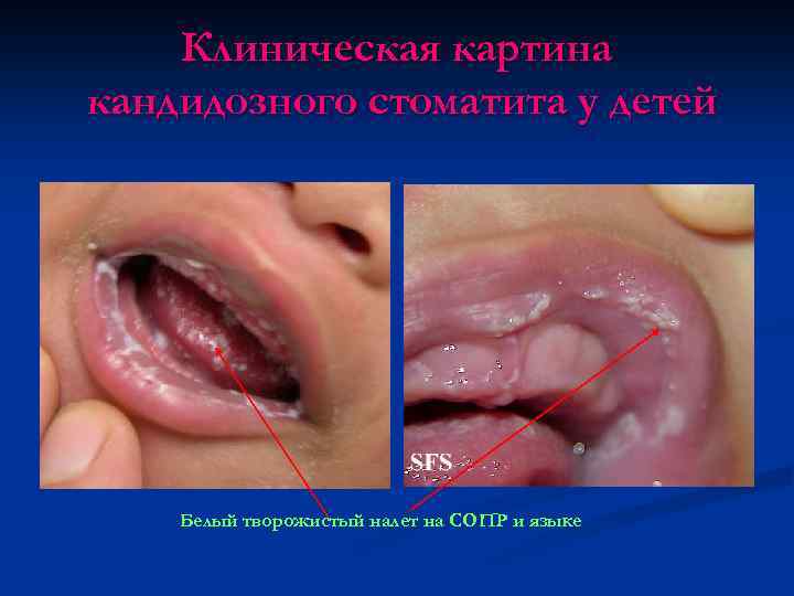 Клиническая картина кандидозного стоматита у детей Белый творожистый налет на СОПР и языке 