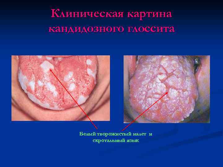 Клиническая картина кандидозного глоссита Белый творожистый налет и скротальный язык 