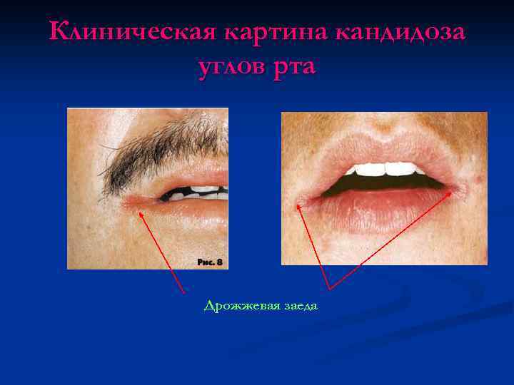 Клиническая картина кандидоза углов рта Дрожжевая заеда 