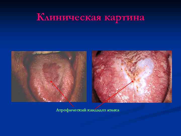 Клиническая картина Атрофический кандидоз языка 