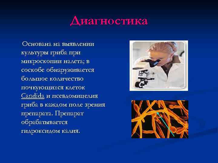 Диагностика Основана на выявлении культуры гриба при микроскопии налета; в соскобе обнаруживается большое количество