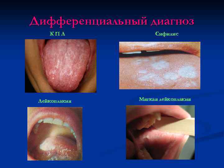 Дифференциальный диагноз КПЛ Лейкоплакия Сифилис Мягкая лейкоплакия 