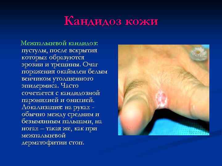 Кандидоз кожи Межпальцевой кандидоз: пустулы, после вскрытия которых образуются эрозии и трещины. Очаг поражения