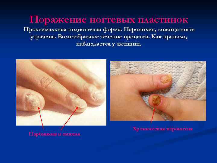 Поражение ногтевых пластинок Проксимальная подногтевая форма. Паронихия, кожица ногтя утрачена. Волнообразное течение процесса. Как