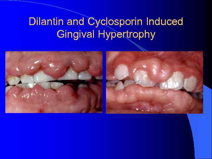 Dilantin and Cyclosporin Induced Gingival Hypertrophy 