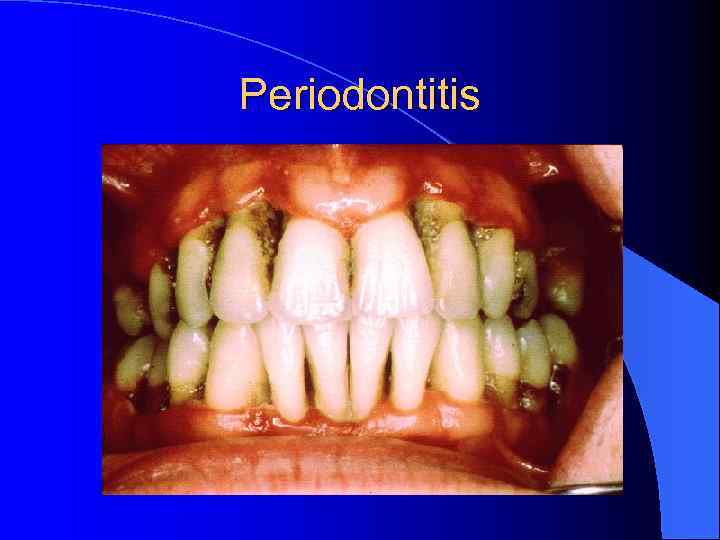 Periodontitis 