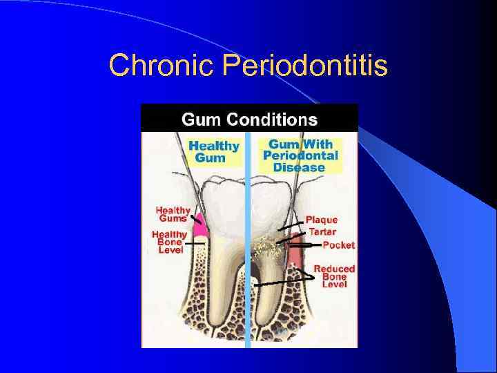 Chronic Periodontitis 