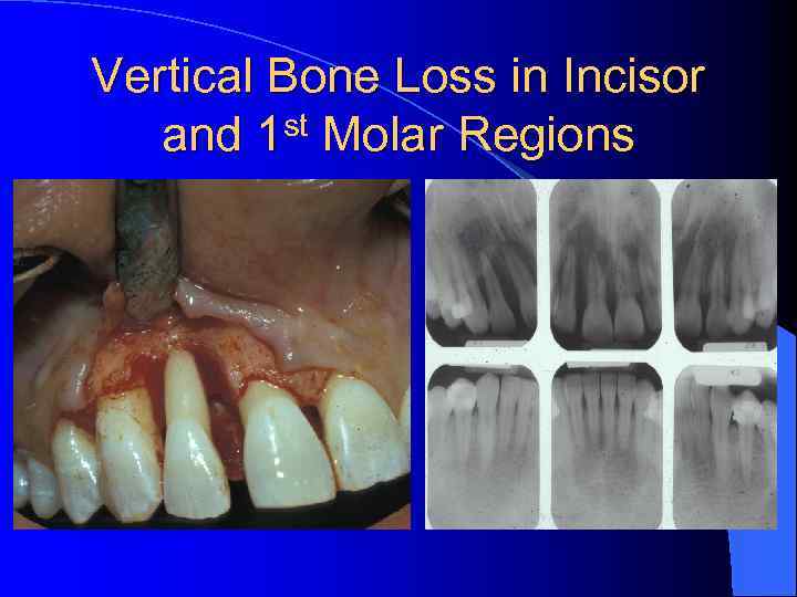 Vertical Bone Loss in Incisor and 1 st Molar Regions 