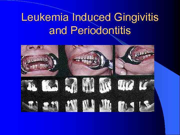 Leukemia Induced Gingivitis and Periodontitis 