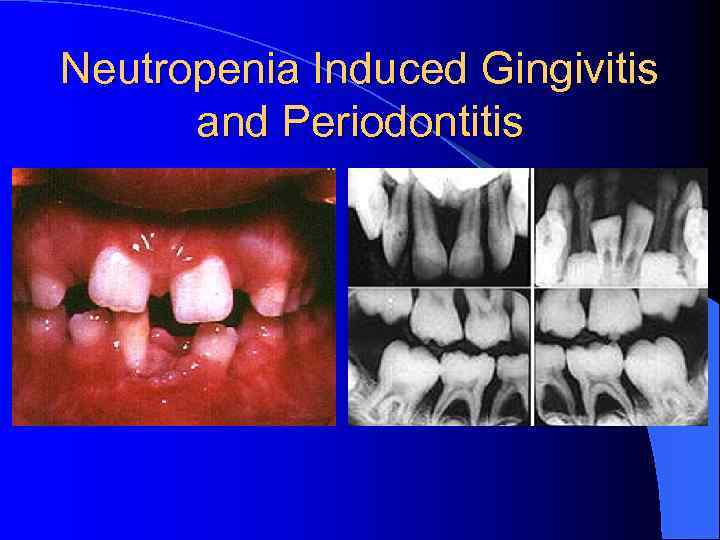Neutropenia Induced Gingivitis and Periodontitis 