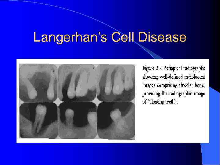 Langerhan’s Cell Disease 