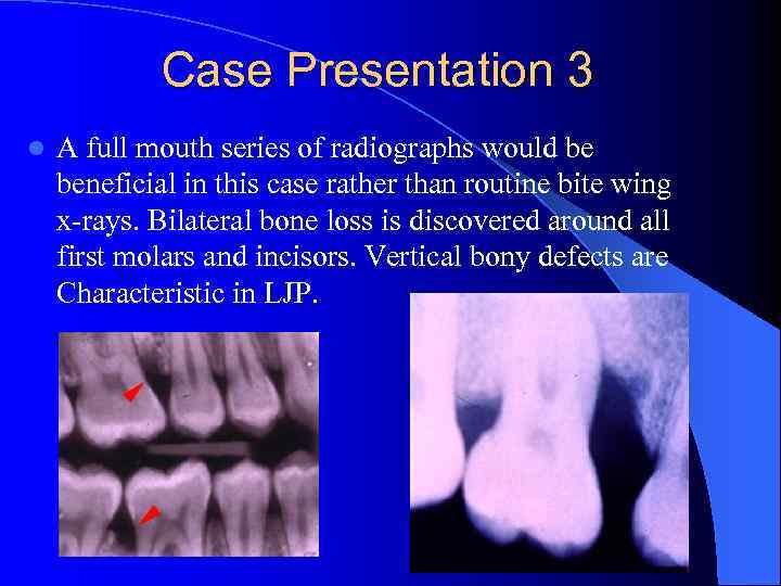 Case Presentation 3 l A full mouth series of radiographs would be beneficial in