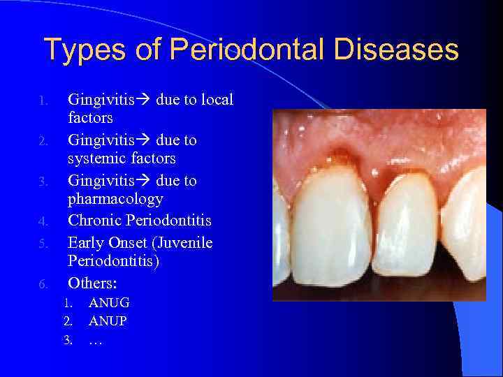 Types of Periodontal Diseases 1. 2. 3. 4. 5. 6. Gingivitis due to local