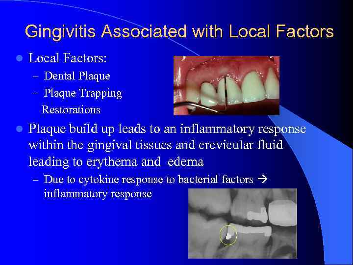 Gingivitis Associated with Local Factors l Local Factors: – Dental Plaque – Plaque Trapping