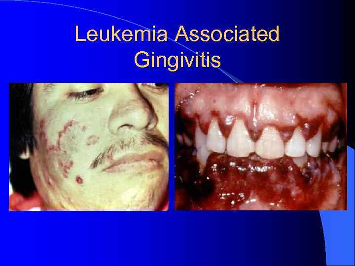 Leukemia Associated Gingivitis 