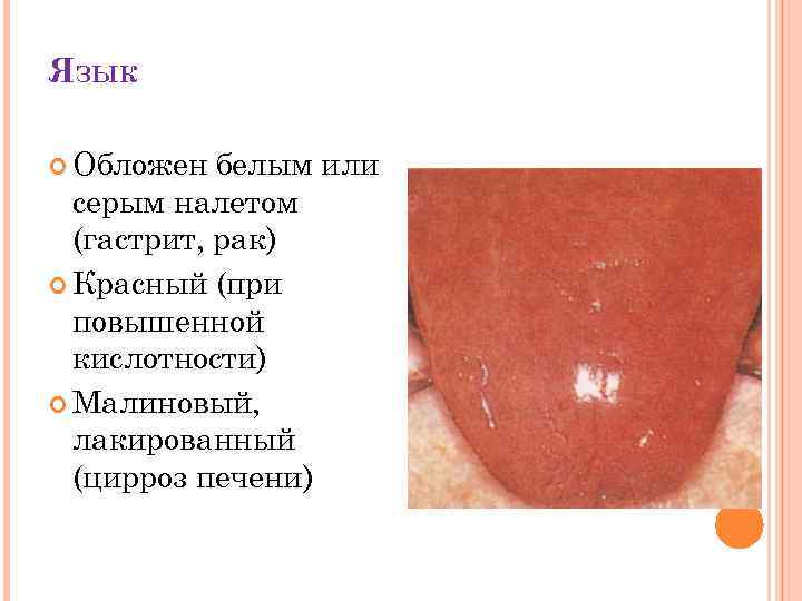 ЯЗЫК Обложен белым или серым налетом (гастрит, рак) Красный (при повышенной кислотности) Малиновый, лакированный