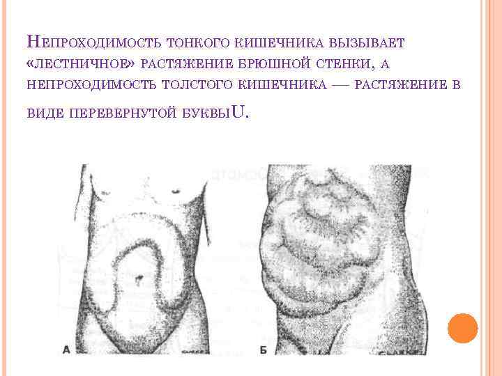 НЕПРОХОДИМОСТЬ ТОНКОГО КИШЕЧНИКА ВЫЗЫВАЕТ «ЛЕСТНИЧНОЕ» РАСТЯЖЕНИЕ БРЮШНОЙ СТЕНКИ, А НЕПРОХОДИМОСТЬ ТОЛСТОГО КИШЕЧНИКА — РАСТЯЖЕНИЕ