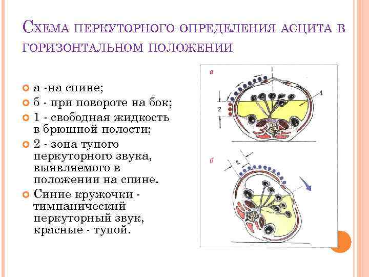 СХЕМА ПЕРКУТОРНОГО ОПРЕДЕЛЕНИЯ АСЦИТА В ГОРИЗОНТАЛЬНОМ ПОЛОЖЕНИИ а -на спине; б - при повороте