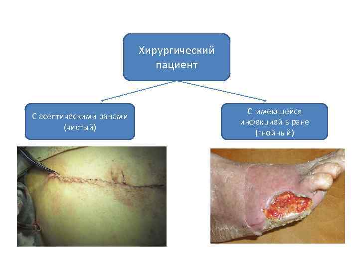 Хирургический пациент С асептическими ранами (чистый) С имеющейся инфекцией в ране (гнойный) 