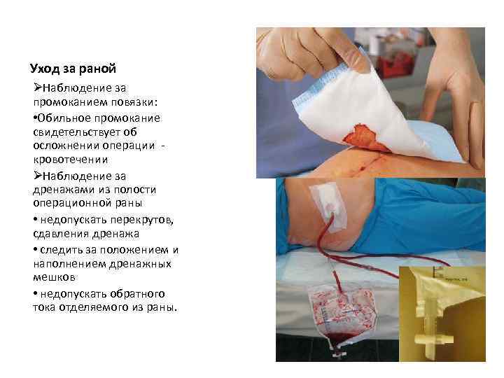 Уход за раной ØНаблюдение за промоканием повязки: • Обильное промокание свидетельствует об осложнении операции