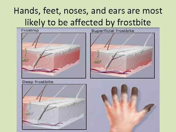 Hands, feet, noses, and ears are most likely to be affected by frostbite 