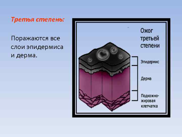 Третья степень: Поражаются все слои эпидермиса и дерма. 