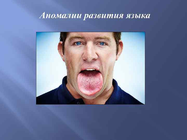 Аномалии развития языка 