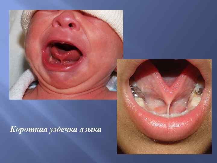 Короткая уздечка языка 