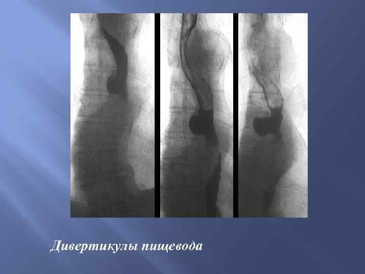Дивертикулы пищевода 