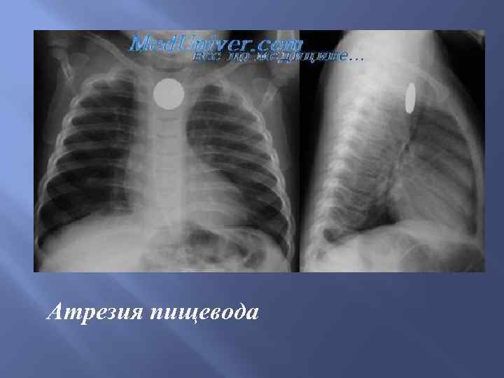 Атрезия пищевода 