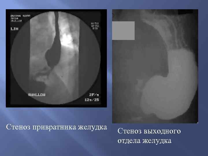 Стеноз привратника желудка Стеноз выходного отдела желудка 