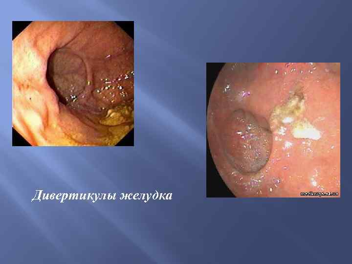 Дивертикулы желудка 