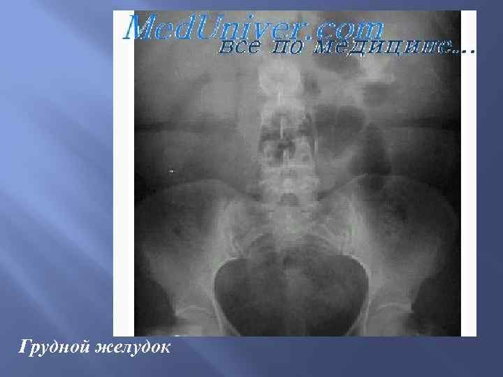 Грудной желудок 